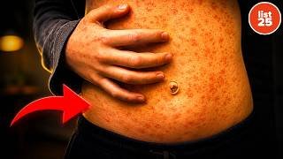 25 Measles Facts People Wish They Knew Sooner